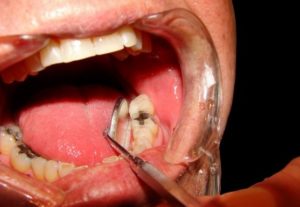 8 nejčastějších důvodů bolesti zubů